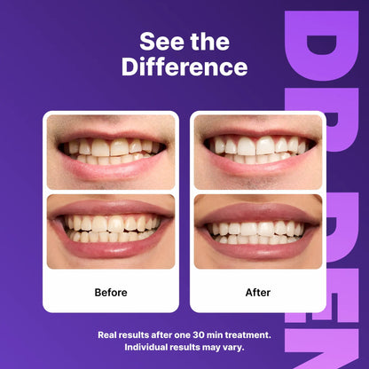 DRDENT Purple Teeth Whitening Strips - 7/21 Whitening Sessions - Safe for Enamel - Non Sensitive Teeth Whitening - Peroxide-Free
